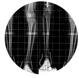Image of an X-ray of somebody with uneven legs